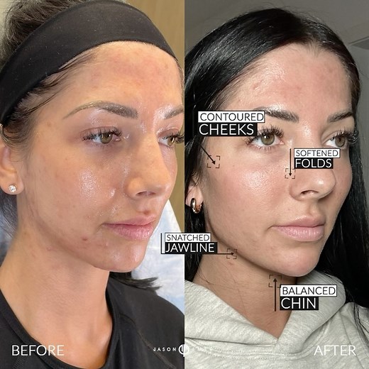 PHENOMENAL FILLER Our patient came to us last week for some facial...