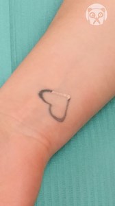 Laser Tattoo Removal! | Creative Panda