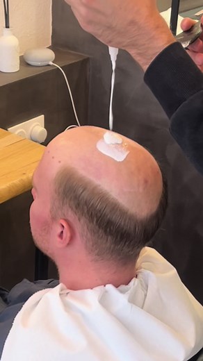 #complementcapillaire #complementcheveux #toupee #toupeeformen #hairreplacement #toupet #hairsupplement #hairtransformation #implantscapillaires #hairsystems #hairpiece #foryou #foryoupage #fyp #hairremplacement #dermofusion