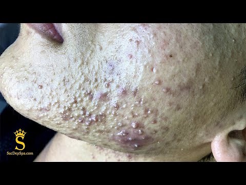 Best Pimple Popping P3 | Mụn Dậy Thì Siêu Hấp Dẫn P3 - SacDepSpa#183