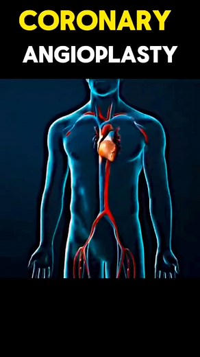 1.6K views · 12 reactions | #About_coronary_angioplasty Coronary angioplasty is a procedure to open clogged blood vessels of the heart. Coronary angioplasty treats vessels, called coronary arteries, which deliver blood to heart muscles. A tiny balloon on a narrow tube, called a catheter, is used to widen a clogged artery and improve blood flow #Like_and_shear #medicineknowledge | Medicine knowledge | Facebook