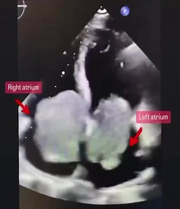 Carney Complex Explanation of the Condition: Carney Complex, also known as Carney syndrome, is a rare genetic disorder characterized by the development of multiple tumors in various parts of the body, including the heart. It is caused by mutations in the PRKAR1A gene. The condition is typically inherited in an autosomal dominant pattern, meaning that a person with one affected parent has a 50% chance of inheriting the condition. Clinical Features: Carney Complex can present with a wide range of