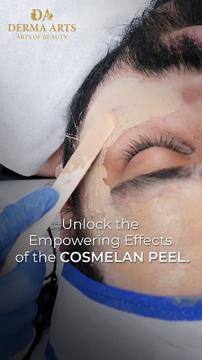 Discover the Cosmelan Peel—a targeted depigmentation treatment meticulously crafted to address melasma, sunspots, and hyperpigmentation. Powered by a potent blend of active ingredients, this peel offers a dual-action approach for gradual, comprehensive improvement in skin tone and texture. Suitable for all skin types, the Cosmelan Peel ensures impressive results with minimal discomfort, prioritizing your safety and beauty. Schedule your appointment for flawless skin with Derma Arts. 📲: 91 92890