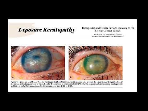 Ocular Surface Disease & Rehabilitation with Scleral Lenses: Fitting & Troubleshooting