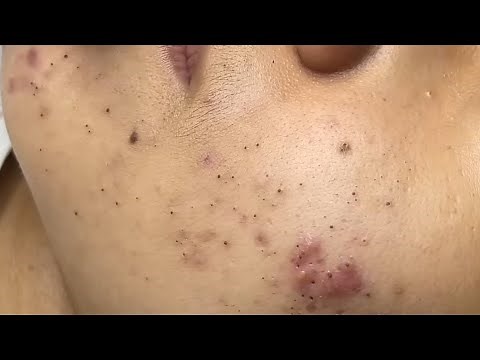 Massive Blackhead Cluster – Cleaned Out Completely ( Linhmydang ) P1