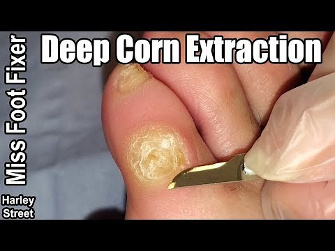 SATISFYING DEEP FOOT CORN REMOVAL BY MISS FOOT FIXER MARION YAU