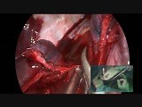 Bleeding Control by Uniportal VATS in a Complex Tumor with Abnormal Artery • Video • MEDtube.net