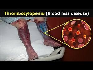 What Causes Low Platelets in our blood? | Thrombocytopenia Disease (3D Animation)