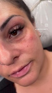 Tear Trough / under eye filler can greatly improve the appearance of hollows under the eyes. More than one session may be required for maximum results ❤️ | Flawless Cosmetic