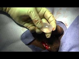 Implantation video