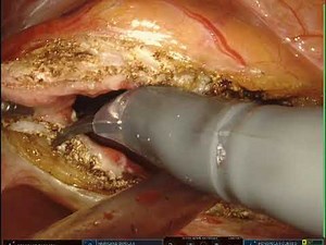 Full-Length, Unedited Robotic Simple Prostatectomy for BPH by Dr. Abaza