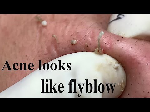 Acne Treatment Huong Beauty Under The Skin #