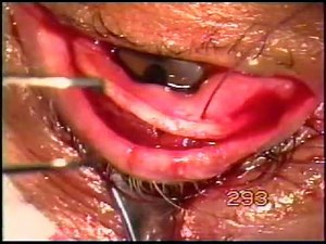 Entropion surgery for upper lid, by Daljit Singh, using Fugo blade