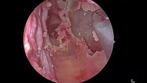 Modified Medial Maxillectomy: Endoscopic Technique and Indications