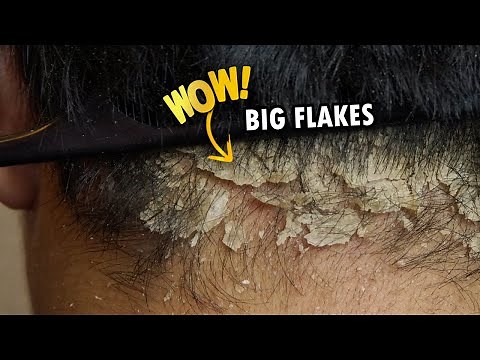 Scratching Psoriasis Big Flakes Back Of Head!! Dandruff Removal Satisfying #357