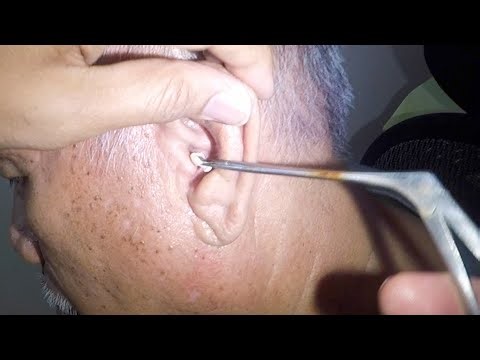 Removing Something White Stuck in GrandPa's Ear | What is It?
