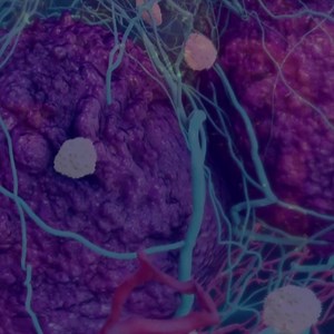 HYPERPROGRESSION https://williamscancerinstitute.com/hyperprogression/ #cancerpatientsupport #cancercare #cancercenter #Immunotherapy #stage4cancer | Williams Cancer Institute