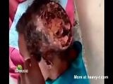 Large Head Sore With Maggots