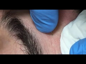 Acne Prevention - Deep Facial Cleansing