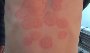Do you have Ringworm? Check the symptoms