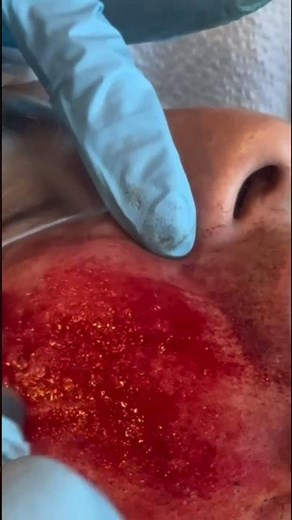 Dermabrasion for acne scars