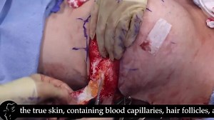 Breast Lift aka Mastopexy after Prior Breast Implants