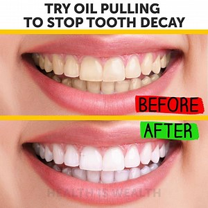 Try Oil Pulling To Stop Tooth Decay: | Smart is the New Sexy