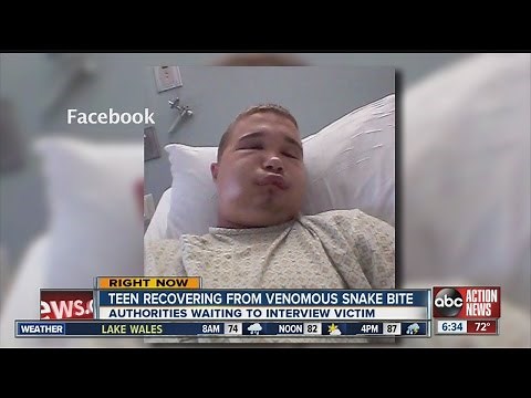 Teen bitten in face by venomous water moccasin