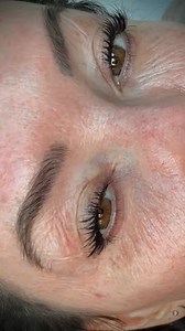 Update : DAY 3 -20% [3 layers] TCA Chemical Peel! If you want more info on TCA you know what to do 👇🏽 #tcarecovery #tcapeeling #tcapeel #chemicalpeel #chemicalpeels #chemicalpeeling | Annie Lewis