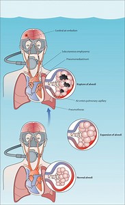 Barotrauma / Decompression Sickness Treatment: Informazioni sul pronto soccorso per Barotrauma / Decompressione - Pronto Soccorso - Emergenza 2026