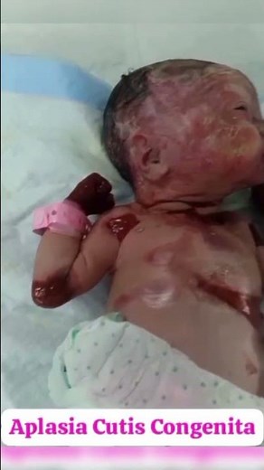 Aplasia Cutis Congenita #Shorts