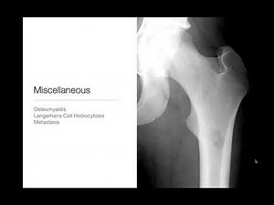 Bone Tumors - Pediatric Bone Tumors - Part 2