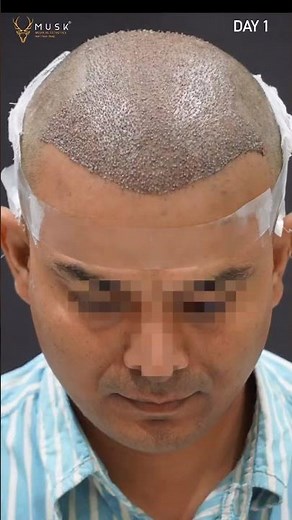 Artas Robotic Hair Transformation Before and After | Musk Clinic Ahmedabad, India