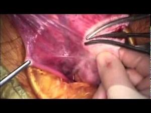 Ovarian Cyst Removal Using a Small Suprapubic Incision • Video • MEDtube.net
