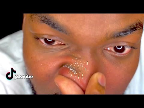 How to remove nose blackheads and clogged oil in nose with 1 finger !
