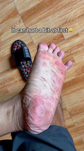 Acupressure Slippers for Foot Pain Relief