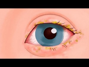 how to get rid of floaters in your eyes naturally