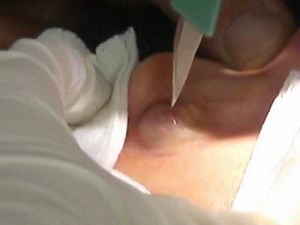 BotFly Maggot Removal