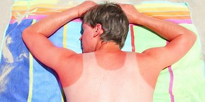 6 Ways to Soothe a Sunburn, According to Dermatologists