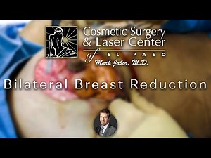 Bilateral Breast Reduction Anchor Incision (Wise Pattern)