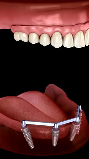 If you’ve lost all your teeth — yes, you can still get implants. And yes, they can change everything. In this video, I explain how placing just a few implants can stabilise your dentures, giving you the freedom to eat, speak, and smile with confidence again. #ProfHowieGluckman #EnamelClinic #DentalImplants #Dentures #Prosthodontics #SmileRestoration #ToothReplacement #ImplantsDentist #PeriodontistCapeTown | Dr Howard Gluckman