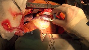 Open Heart Surgery LIve