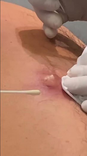PUS-FILLED ABSCESS!