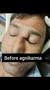 21K views · 242 reactions | Sebaceous cyst remove by agnikarma #videochallenge #shortsreels #share #beautychallenge #reel #vedioviralreel | Vaidya Pawan Kaushik | Facebook