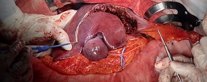 Open Radical Cholecystectomy with Partial Hepatectomy for Gallbladder Cancer | Journal of Medical Insight