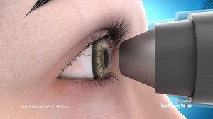 Laser Trabeculoplasty for Glaucoma