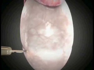 Sperm Extraction: MicroTESE and Multiphoton Microscopy • Video • MEDtube.net