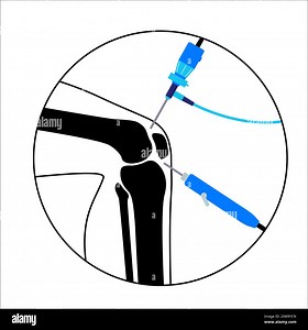 Illustration of knee joint arthroscopy procedure. This is a procedure for diagnosing and treating joint problems. A surgeon inserts a narrow tube attached to a fibre-optic video camera through a small incision Stock Photo - Alamy
