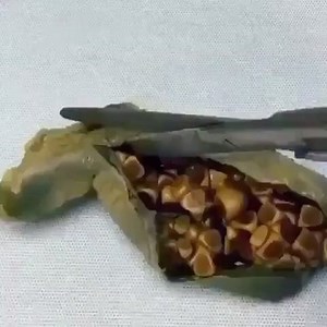 The bile components that form gallstones include cholesterol, bile...