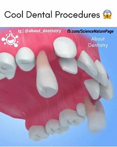 2.3K views · 48 reactions | Dental Procedures  | About Dentistry | Facebook
